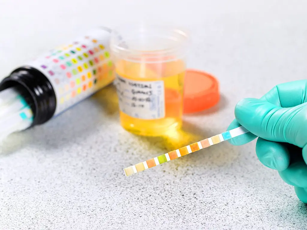 A gloved hand holding a test paper strip in front of a urine sample