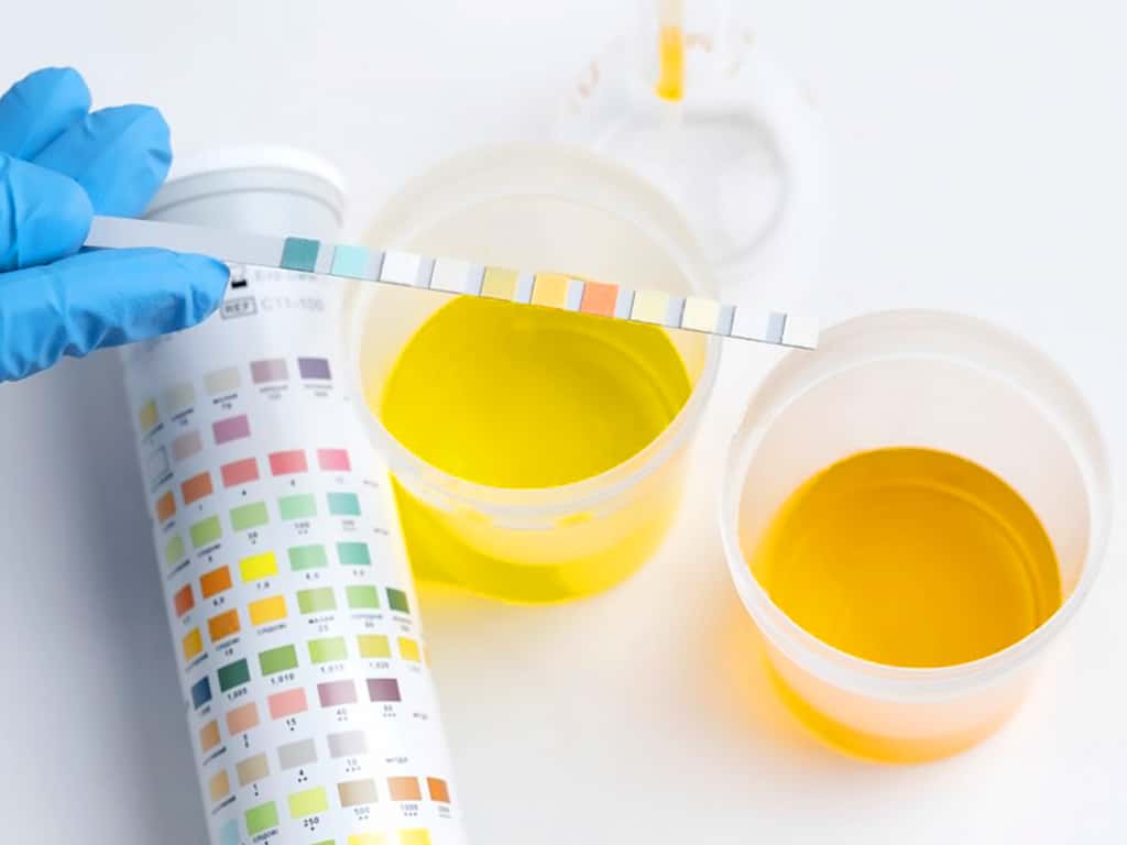 A testing strip alongside two containers of urine samples