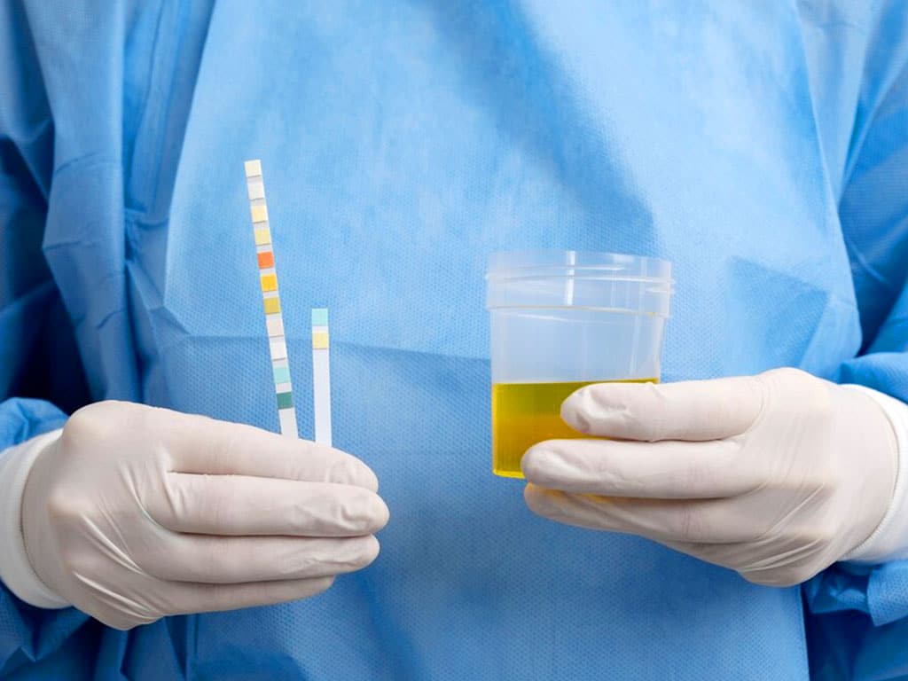 A medical professional holding a urine sample container, a dipstick, and colour chart