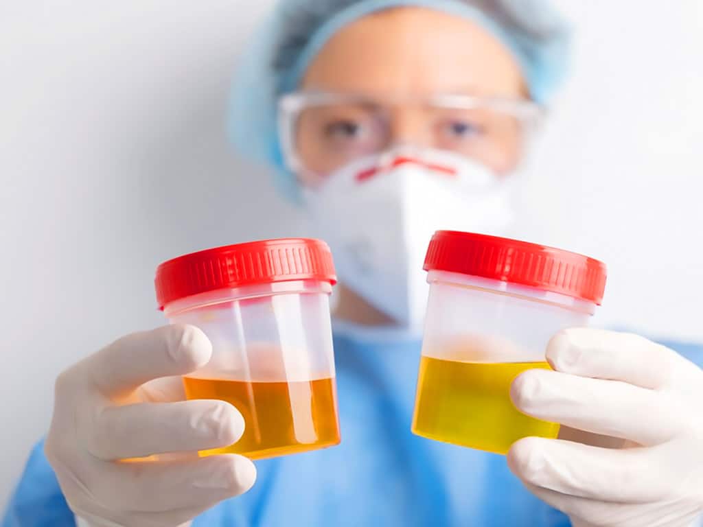 A lab technician holding urine sample containers with both hands